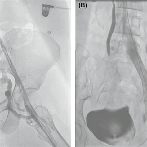 A Venography Showed Occlusion Of Left Common Iliac Vein B Common Download Scientific Diagram