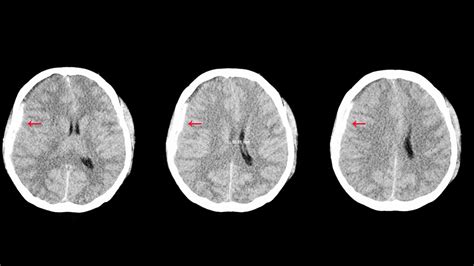 Qué Es Y Cómo Se Trata El Hematoma Subdural Con El Que Fue Diagnosticado Ginés González García