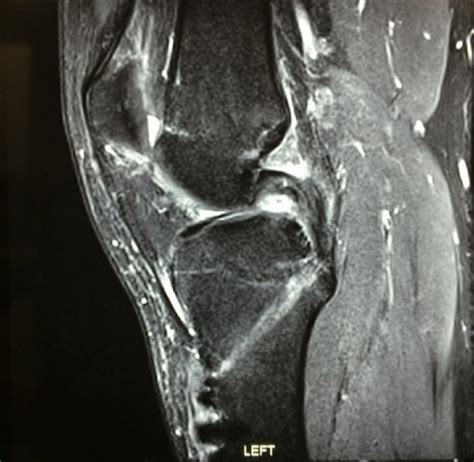 Knee Pcl Tears Avalon Orthopaedic