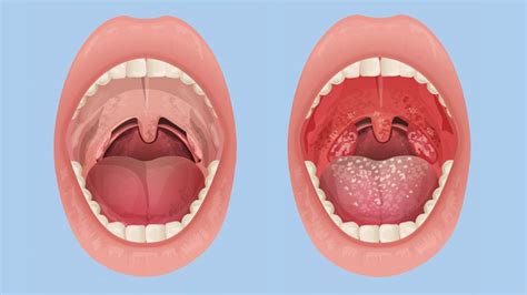 How Do You Know if You Have Tonsillitis? | Everyday Health