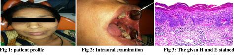 Figure From Oral Lichenoid Reaction Associate With Amalgam