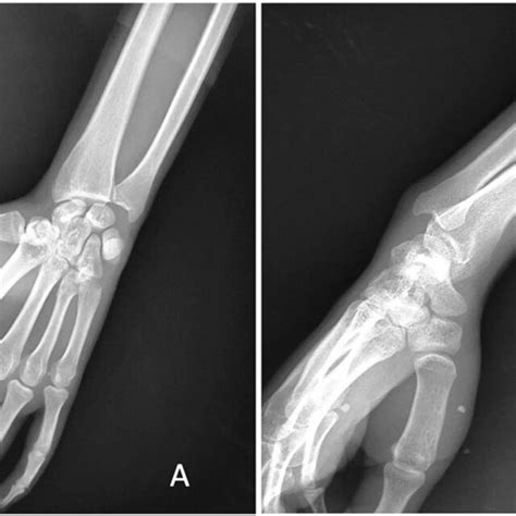 Standard Radiograph Showing Overlap Of Ulnar Head And Inferior End Of