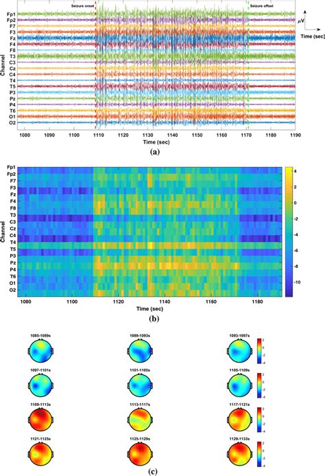 A Epileptic Seizure EEG Example From DB1 The Red Marker Indicates The