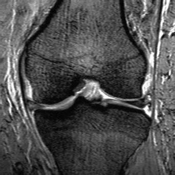 Pdf Mri Findings In Knee Osteoarthritis