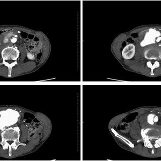 A Contrast Enhanced Computed Tomography Scan Revealed An Abdominal