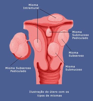 Miomectomia uterina Dra Remédios Pacheco Reprodução Humana 85