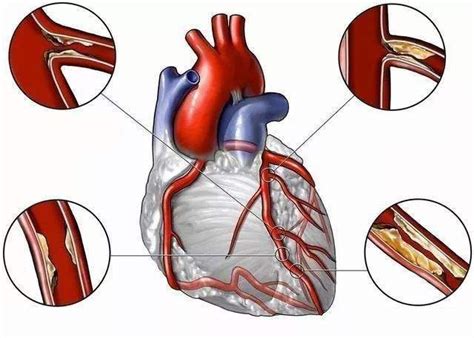 心肌缺血，心肌缺血的原因