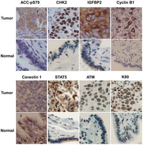 Examples Of Aberrant Expression Of 8 Molecules In Tumor Download