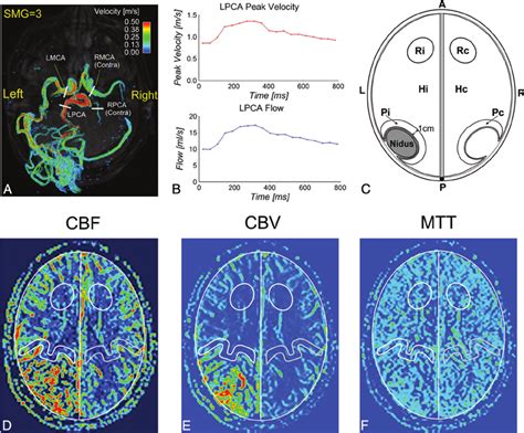 3D Blood Flow Visualization In A Left Medial Occipital AVM AVM 17