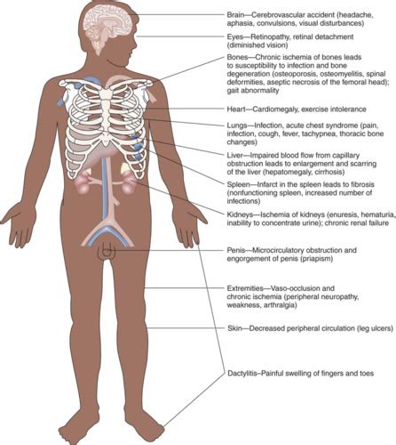 Allergies Immunology Hematology Flashcards Quizlet