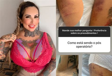 Sabrina Boing Boing Compara Seios Após Colocar 6 Litros De Silicone E Fala De Pós Operatório