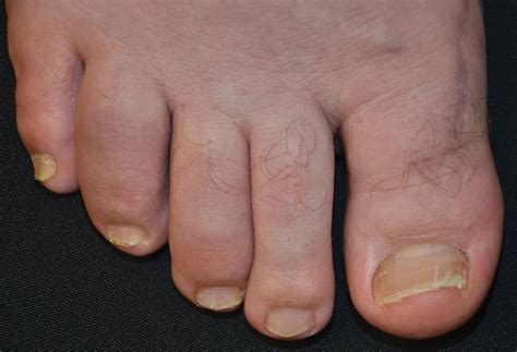 Psoriatic Arthritis Toes