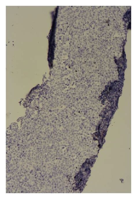 Adrenal Biopsy Immunohistochemical Staining Showing Negative Cd