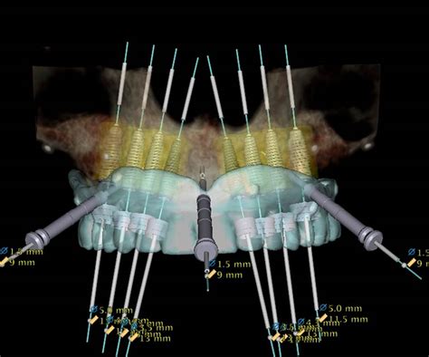 Guided Implant Surgery - Scarsdale, NY • NYOMIS Oral Surgery