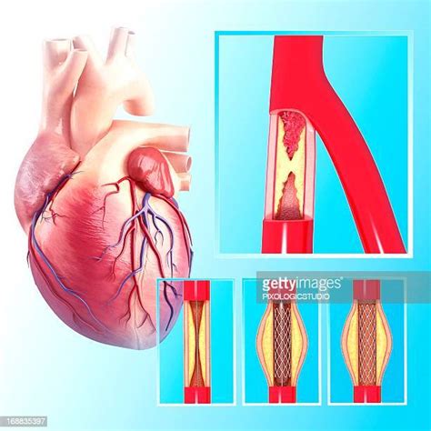 107 Arterial Stent High Res Illustrations Getty Images