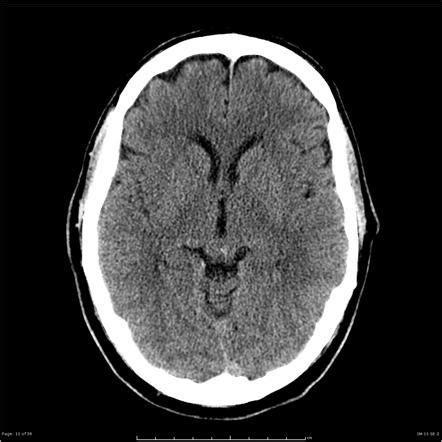 Glioblastoma IDH wild-type | Radiology Case | Radiopaedia.org