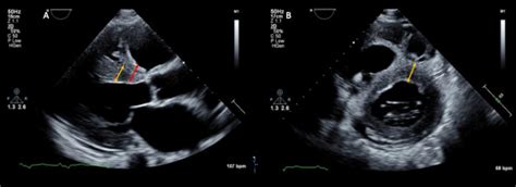 Practical Points For Echocardiography In Cardiac Amyloidosis Journal