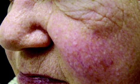 Cutaneous Manifestations Of Internal Malignancy Thiers Ca A