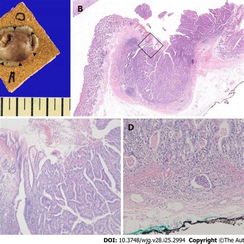 Pathology Of The Endoscopically Resected Lesion A Gross Appearance Of