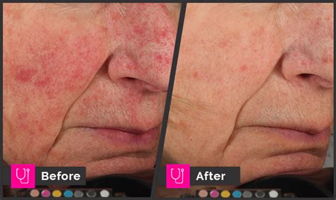 Rosacea Prima Rx Right Main Line For Laser Surgery In Ardmore Pa