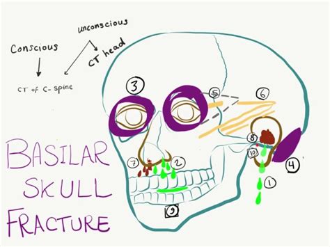 Basal Skull Fracture Complications Symptoms