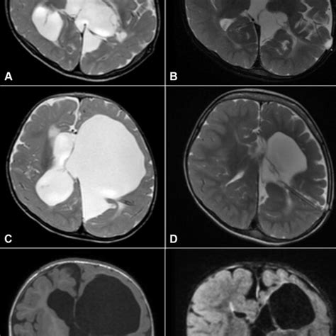 Axial T2 Weighted Ad And Coronal T1 Weighted Ef Mri Sequences Of