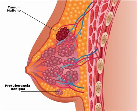 Lo que debo saber sobre Cáncer de Mama INCART