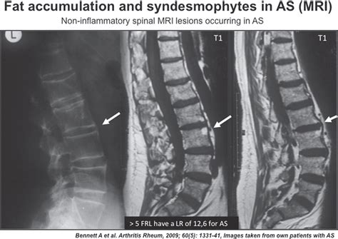 Ankylosing Spondylitis Mri