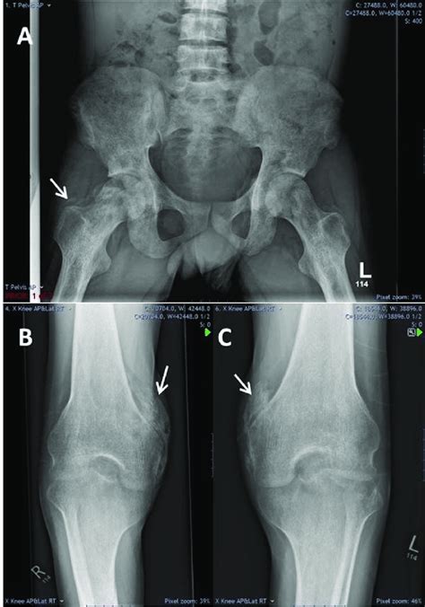 Pelvic And Knee X Rays Showing Heterotopic Ossification Plain Download Scientific Diagram