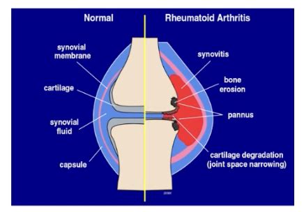 Msk Lupus And Immune Related Connective Tissue Disease Flashcards