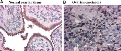 Ihc Analysis Of C Jun Expression In Human Ovarian Cancer Tissue