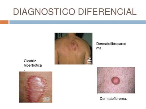 Queloide Y Cicatrices Hipertroficas