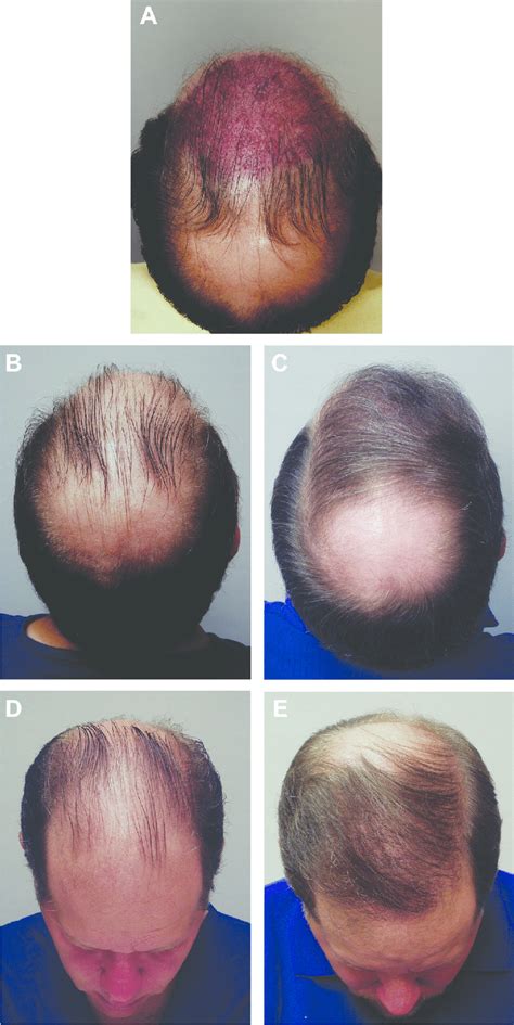 This Year Old Man With Male Pattern Hair Loss Requested Hair