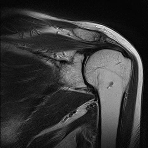 Base Of Coracoid Process Fracture Image