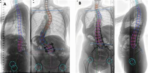 54 Year Old Female With An Idiopathic Curve Progressing Into Adulthood