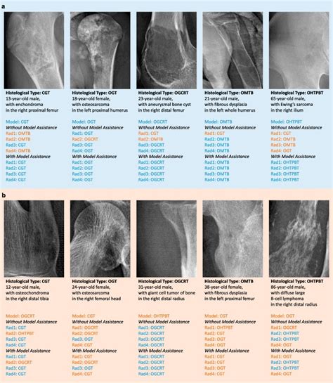 A Radiograph Based Deep Learning Model Improves Radiologists