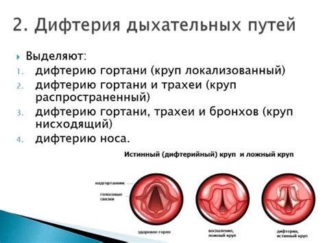 Дифтерия - презентация онлайн