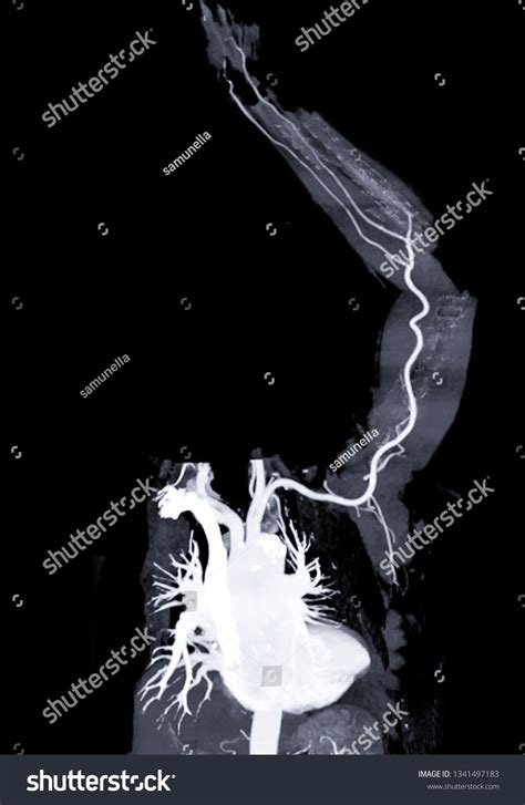 Cta Left Brachial Artery Ct Scan Stock Illustration 1341497183