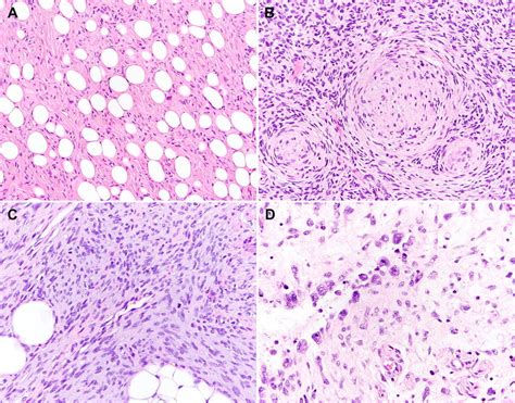 Dermatofibrosarcoma Pathology Outlines