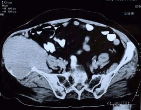 Full Text Giant Cell Tumor Of Bone Report Of Three Cases With Unusual Locations