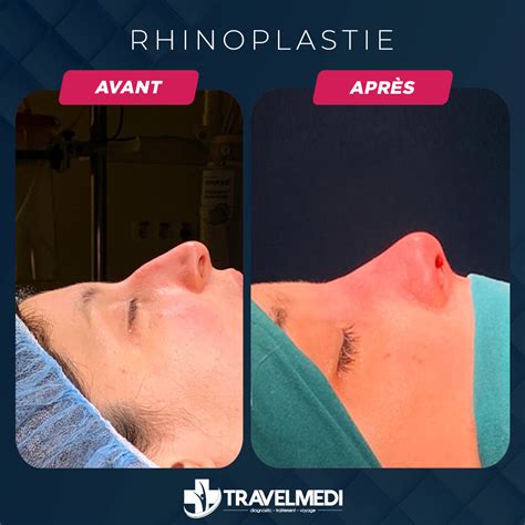 Rhinoplastie En Turquie Coût Avant Après 2024