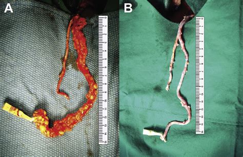 No Touch Saphenous Vein Harvesting May Improve Further The Patency Of