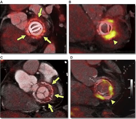 Post Operative Inflammation Versus Infective Endocarditis In Prosthetic