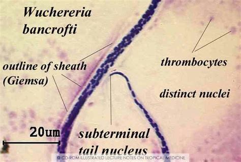 Wuchereria bancrofti | Lectures notes, Lab tech, Microbiology