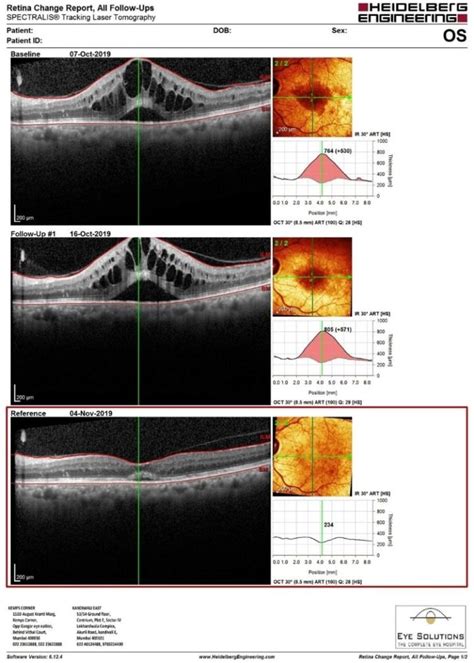 OCT Eye Test | Retina and Glaucoma | Mumbai | Eye Solutions