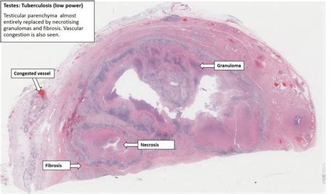 Testis Tuberculous Epididymitis Nus Pathweb Nus Pathweb