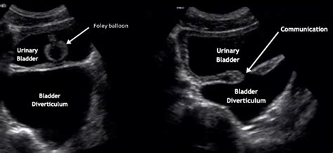 Bladder Diverticulum Ultrasound