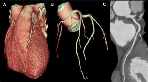 Coronary Ct Angiography Ccta Centre De Cardiologie