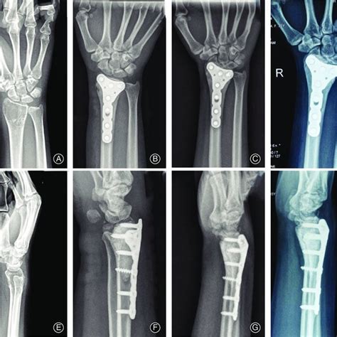 An Illustrative Case Of Giant Cell Tumor Of The Bone Gctb Of The