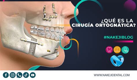 BLOG Qué es la cirugía Ortognática Clínica Dental Nakeji